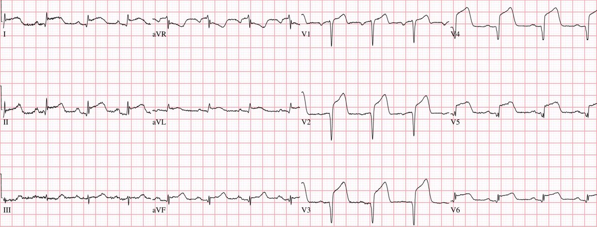 EM_RESUS's tweet photo. Here’s the #ECG of a 40-year-old man who developed severe chest pain after using Crystal Meth 

What’s the diagnosis? https://t.co/uMewqwU9sV