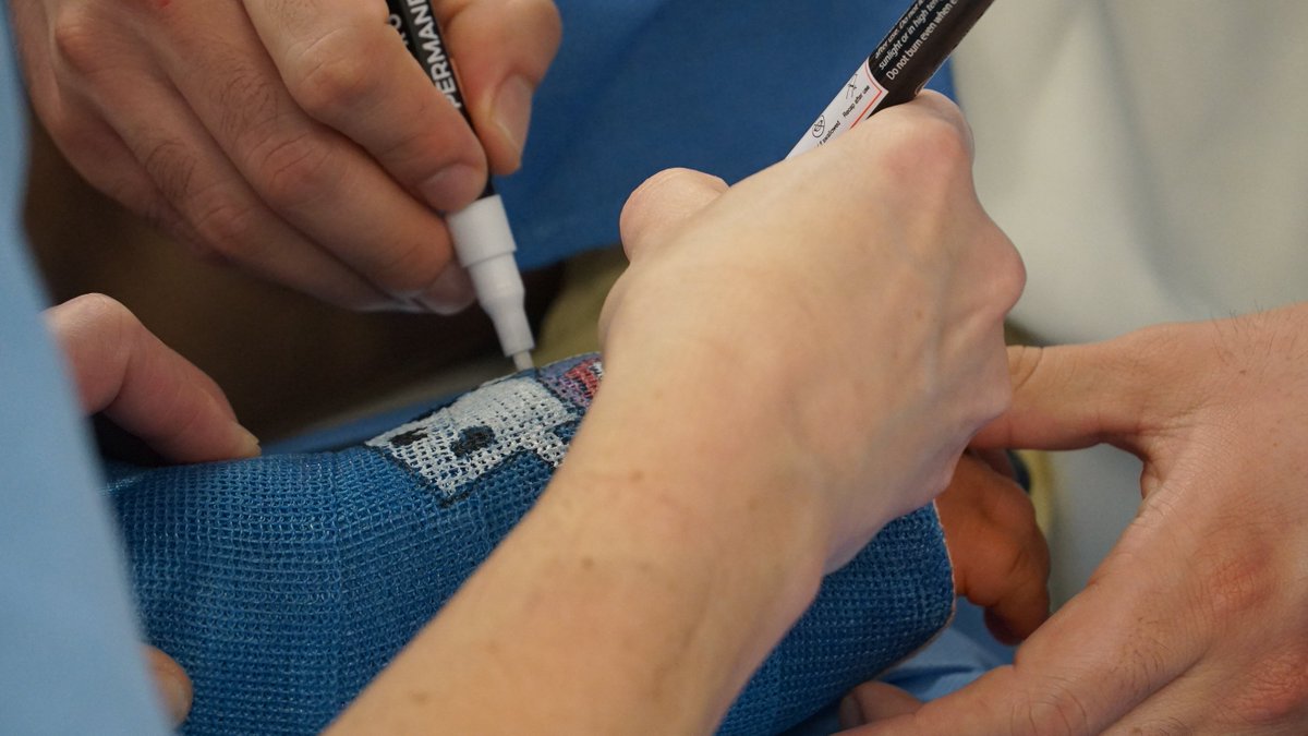 Orthopedic surgeon Felicity Fishman, MD, is featured in today's <a href="/washingtonpost/">The Washington Post</a> Inspired Life column. Her colorful art does more than just brighten patients' casts after hand or upper extremity surgeries.
We're gifting this article to read here: wapo.st/3JeHOOQ