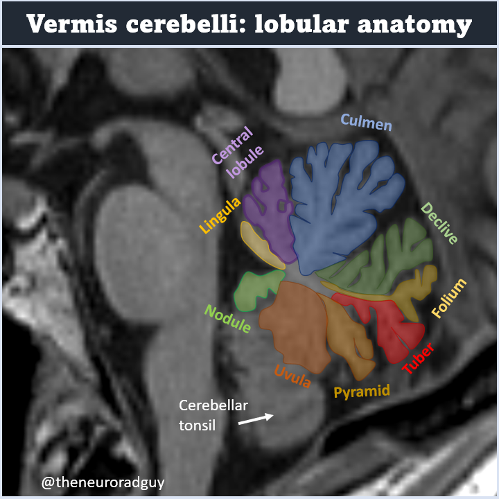 theneuroradguy's tweet photo. Small but beautiful: lobular anatomy of the vermis. A step-by-step tweetorial with many useful mnemonics can be found on the page of 
@teachplaygrub; nice illustrations of the same anatomy can be found on the page of the excellent 
@drharunyildiz. #FOAMrad #FOAMed #neurorad https://t.co/mTBfOL81IJ