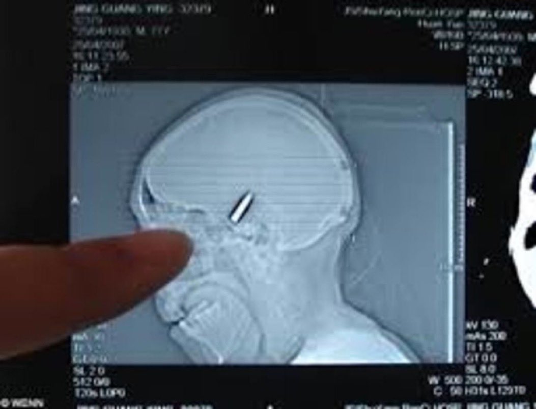 Lencyclopediste's tweet photo. En 2007, un homme de Floride s'est présenté à l'hôpital en se plaignant d'un « mal de tête ». Après examen par un médecin, une balle a été découverte coincée dans son crâne. Sa femme lui avait tiré une balle dans la tête pendant qu'il dormait. https://t.co/yJcf8V87eM