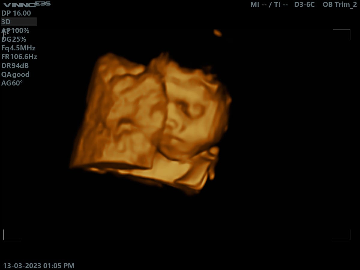FlashmedSaudi's tweet photo. VINNO E35 … 4D images
For order and details contact on WhatsApp:
https://t.co/eDyZsKzdHB
#flashmed
#vino
#ultrasound https://t.co/ApsAUSnZiz