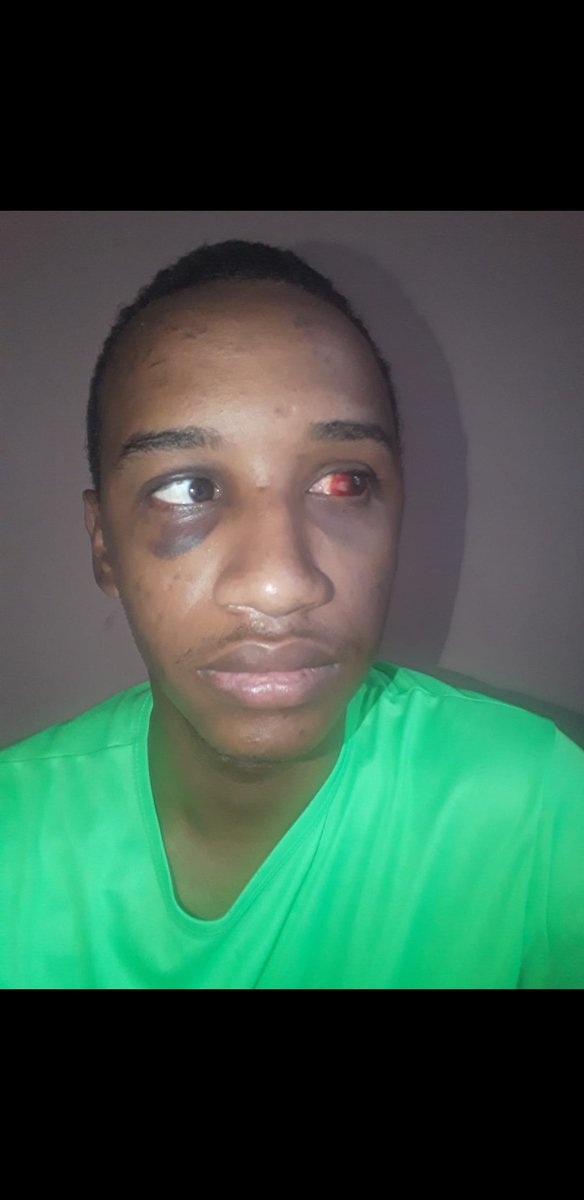LucasFranco49's tweet photo. Depois da tentativa de homicídio sofrida e do descaso da UFRJ, o centro acadêmico de engenharia realiza uma vaquinha para ajudar a custear algumas coisas básicas ao Lucas. 
Exame, colírio, remédios.
Qualquer valor ajuda muito para a recuperação dele. https://t.co/aFZ6849wNR