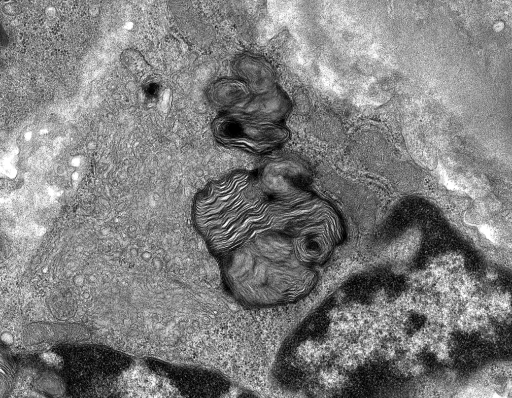 JZRenalPath's tweet photo. Interesting case with zebra bodies restricted to scattered endothelial cell cytoplasm. Pt is on hydroxychloroquine which is the likely etiology for these findings. #renalpath #pathtwitter https://t.co/V06GLPM2zI