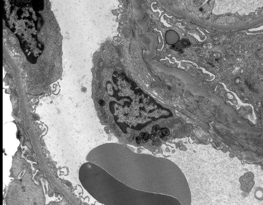 JZRenalPath's tweet photo. Interesting case with zebra bodies restricted to scattered endothelial cell cytoplasm. Pt is on hydroxychloroquine which is the likely etiology for these findings. #renalpath #pathtwitter https://t.co/V06GLPM2zI