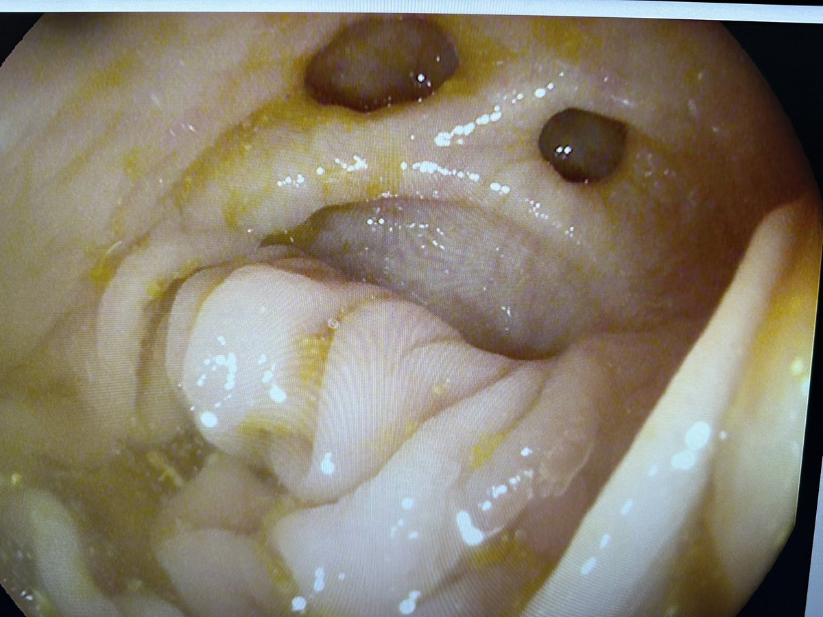 SamSchuelerMD's tweet photo. When diverticula in a tortuous sigmoid colon appear to be mocking your fellow 🤣🤣 @JennieZhang12 @Mooufy @GW_Gastro @AmerGastroAssn @AmCollegeGastro @GWSMHS @GW_MFA #GITwitter https://t.co/WfYjLBFtpj
