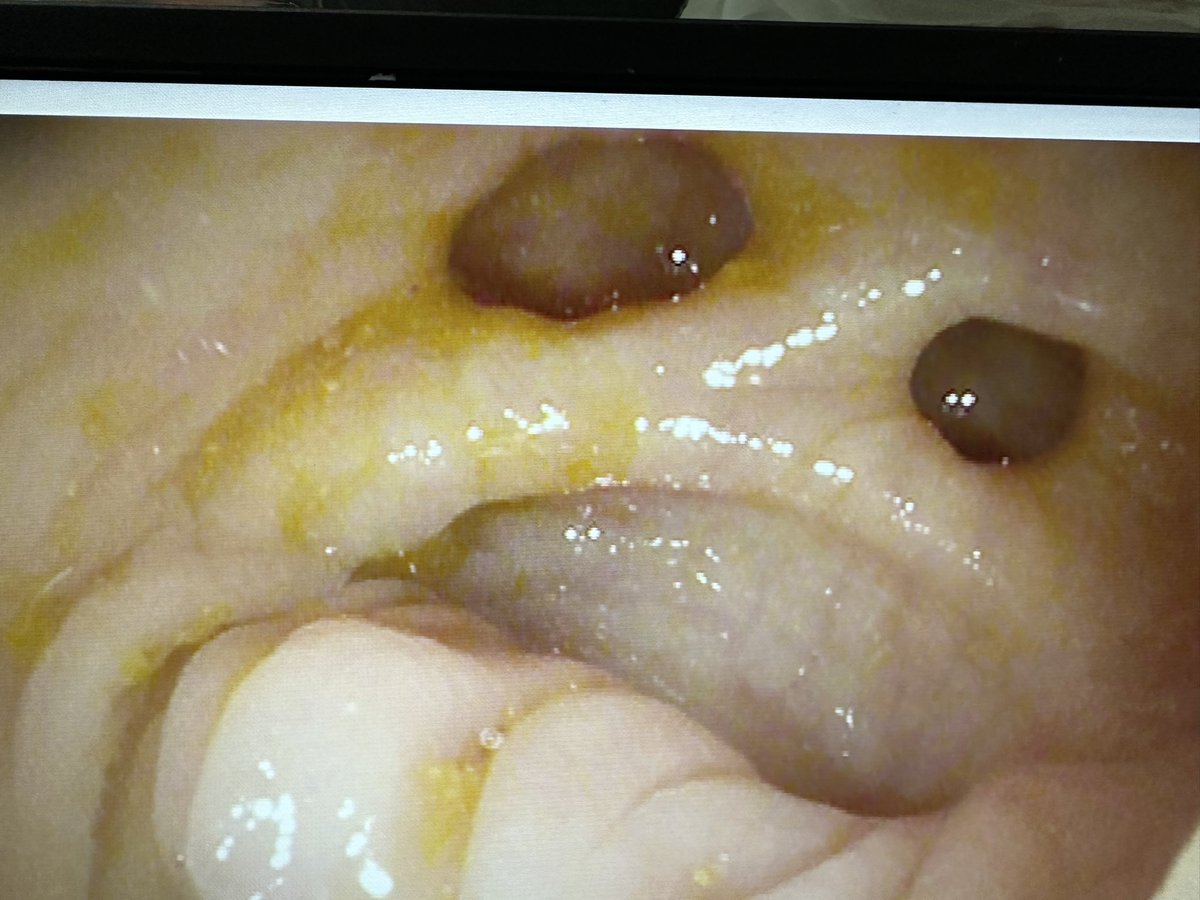 SamSchuelerMD's tweet photo. When diverticula in a tortuous sigmoid colon appear to be mocking your fellow 🤣🤣 @JennieZhang12 @Mooufy @GW_Gastro @AmerGastroAssn @AmCollegeGastro @GWSMHS @GW_MFA #GITwitter https://t.co/WfYjLBFtpj