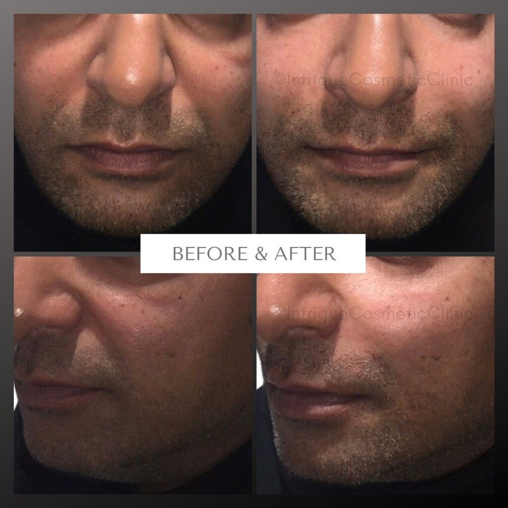 What a transformation! 
A lot can be achieved with a little filler! We treated this client's cheek area to give structural support and lift to the mid and lower face, and then added extra to the nose-to-mouth lines to smooth and give an overall refreshed… instagr.am/p/Cp3KrS4o0gI/