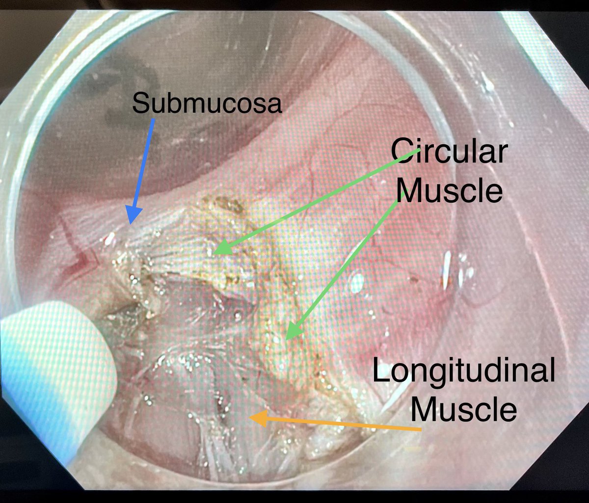 POEM - per oral endoscopic myotomy.

View form in the submucosa tunnel:
Good to understand the anatomy.

#Endoscopy #Achalasia 
#GITwitter 
#MedEd #Gifellows