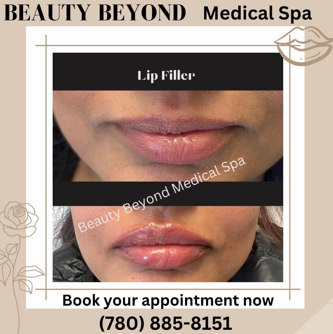 Edmonton

Who says you can't achieve your dream lips?

Book your appointment with Beauty Beyond Medical Spa to make it a reality!

Book your appointment now 
Tel. (780)885-8151
Or visit bbmedicalspa.com

#lebanezalbertanews
#beaytybeyond #lips #filler #beauty #greatprices