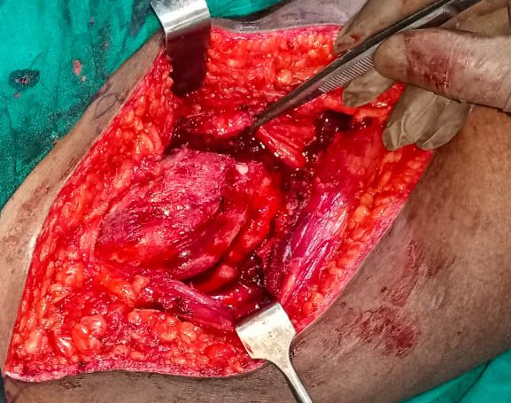 centerofhip's tweet photo. If  someone reverse engineers the “technology” of  HO production in humans, nonunions would become history imo. 
See the amount of high quality “bone graft” obtained on excision of HO to get the hip mobile in this young chap.
#orthotwitter https://t.co/OSP8DlYatf