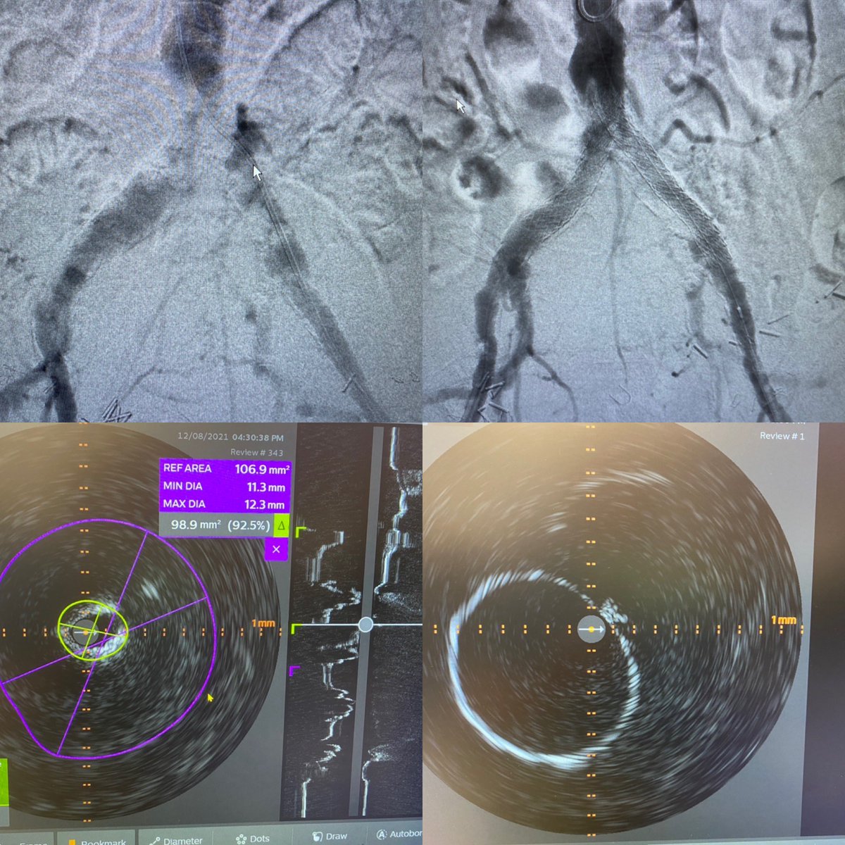Leigh Ann O'Banion (@limbsalvagedr) on Twitter photo <a href="/academicaorta/">Saideep Bose MD, MPH</a> <a href="/VascularSVS/">Vascular SVS</a> <a href="/AIrshad_MD/">Ali Irshad, MD RPVI</a> <a href="/thesurgerylife/">Eli EK MD</a> <a href="/martknowles/">Martyn Knowles, MD, MBA</a> I dunno but this uniform luminal gain makes me feel oh so happy, and i'm not sure u get that without <a href="/ShockwaveIVL/">Shockwave Medical</a> <a href="/academicaorta/">Saideep Bose MD, MPH</a> <a href="/VascularSVS/">Vascular SVS</a> <a href="/AIrshad_MD/">Ali Irshad, MD RPVI</a> <a href="/thesurgerylife/">Eli EK MD</a> <a href="/martknowles/">Martyn Knowles, MD, MBA</a> I dunno but this uniform luminal gain makes me feel oh so happy, and i'm not sure u get that without <a href="/ShockwaveIVL/">Shockwave Medical</a>
