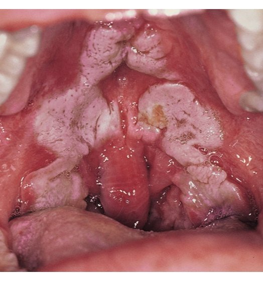 MoreXGrok's tweet photo. What is the diagnosis?

Diphtheria 

Secondary syphilis 

Oral leukoplakia 

Candida 

Ludwig's angina https://t.co/mEj4bYF6kU