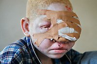 Think about this today,

Albinism does not usually affect lifespan. But, in Africa skin cancer ends the life of 90% people with albinism before reaching the age of 30.😢