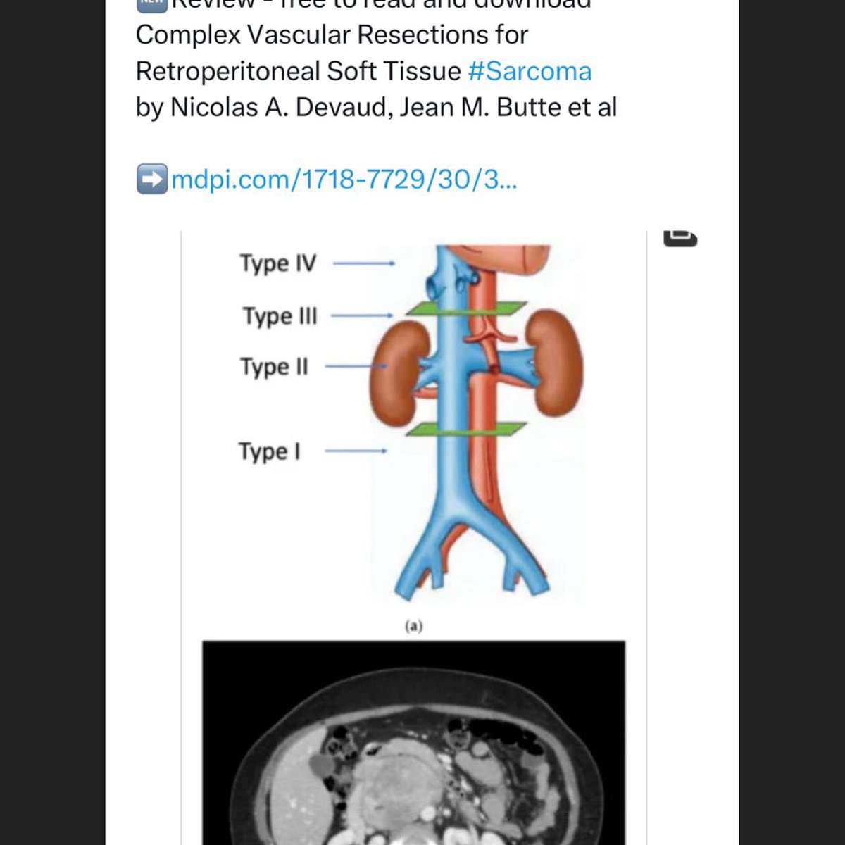 Vascular resection, the next margin!