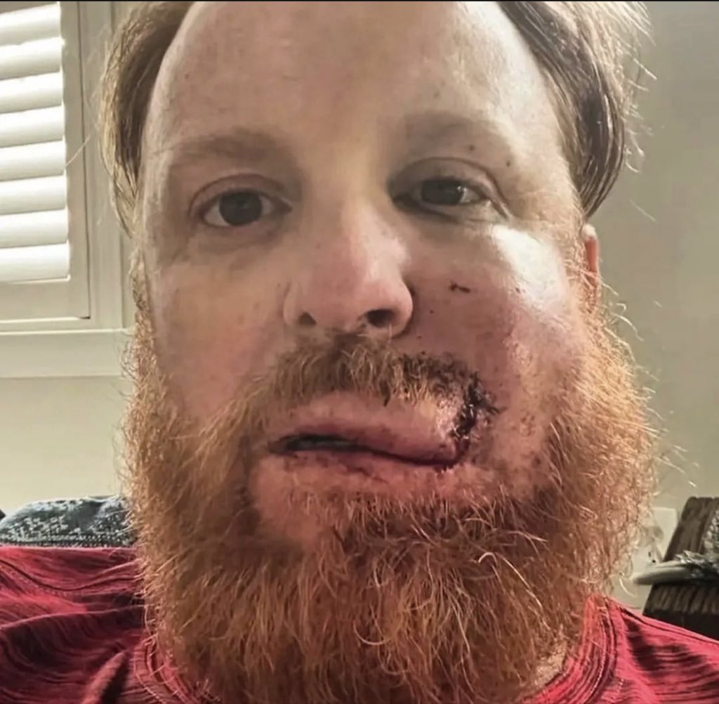 BenVerlander's tweet photo. Justin Turner shared some pictures of his face after getting hit… 🤯 https://t.co/0hdH2uIGPJ