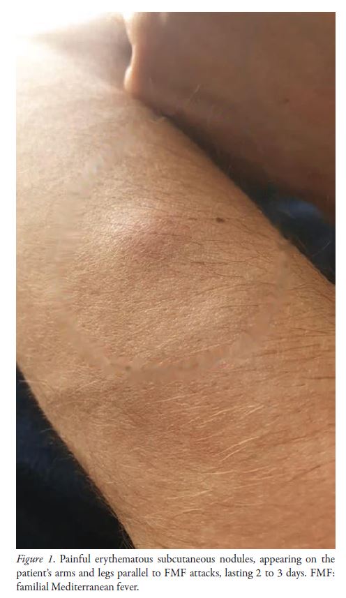 Images in Rheumatology

Autoinflammatory Diseases and Vasculitis: The Missing Link

📰 jrheum.org/cgi/content/fu…

#familialmediterraneanfever #autoinflammatorydiseases #vasculitis