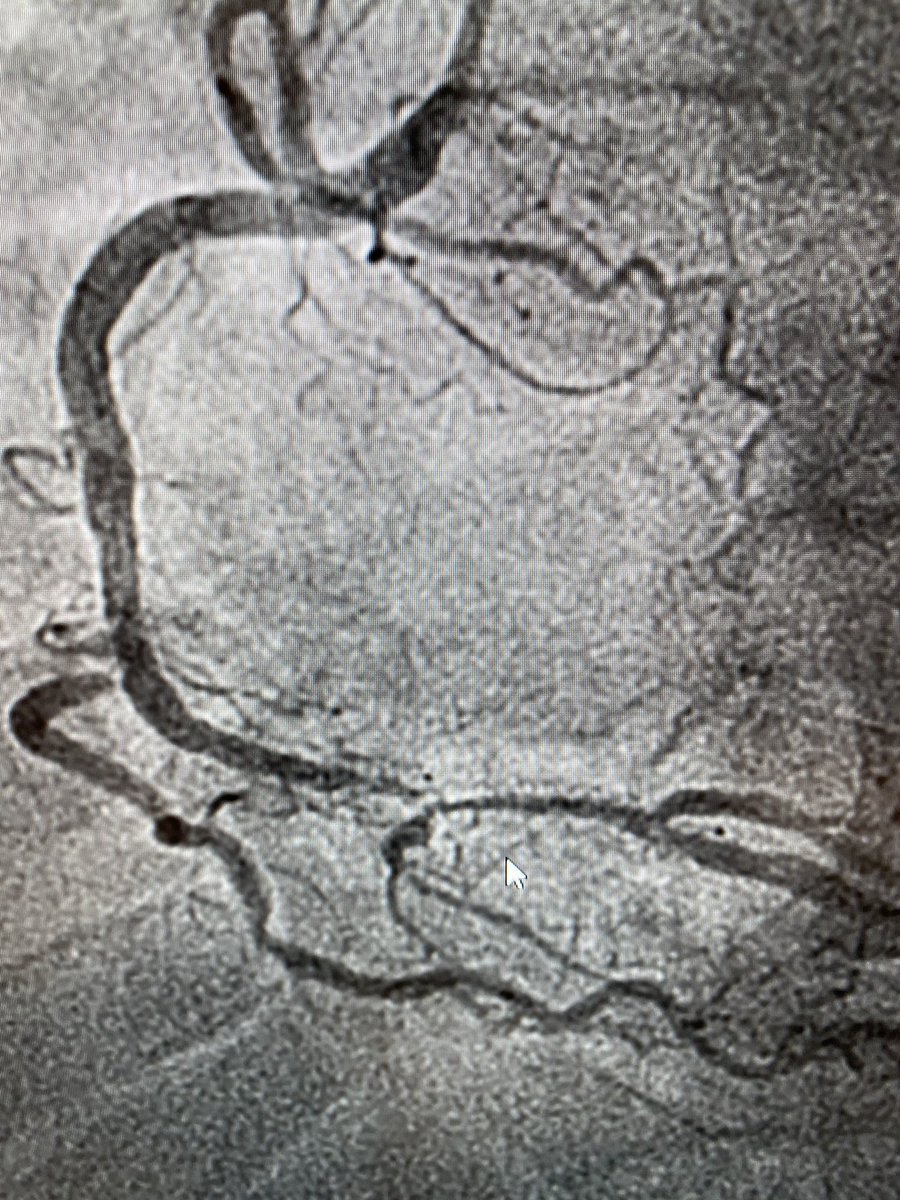 DocSavageTJU's tweet photo. dRCA BMS from 1990s. Stent has prox +distal⚫️with faint spine↘️ What BMS is this? Take #CardioQuiz poll on RP. #ICHistory (new#) #CardioTwitter @mmamas1973 @djc795 @mirvatalasnag @GreggWStone @Drroxmehran @CMichaelGibson @angioplastyorg @Pooh_Velagapudi @fischman_david @jscai https://t.co/KOODezgHLU