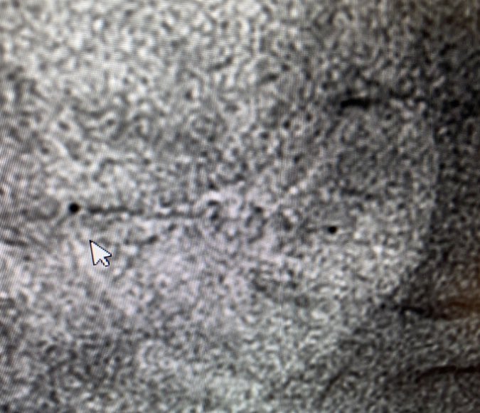 DocSavageTJU's tweet photo. dRCA BMS from 1990s. Stent has prox +distal⚫️with faint spine↘️ What BMS is this? Take #CardioQuiz poll on RP. #ICHistory (new#) #CardioTwitter @mmamas1973 @djc795 @mirvatalasnag @GreggWStone @Drroxmehran @CMichaelGibson @angioplastyorg @Pooh_Velagapudi @fischman_david @jscai https://t.co/KOODezgHLU