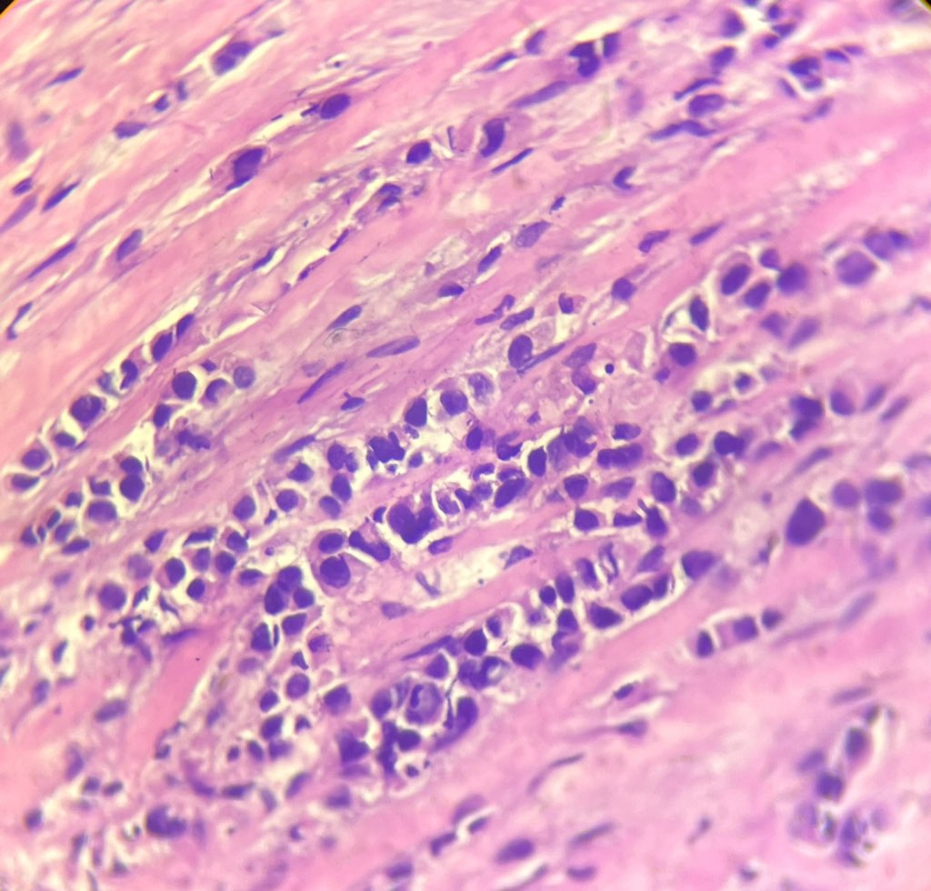 52 yr old male Incisional biopsy from lower lip tumor Your thoughts? #PathTwitter #residentPath #OralPath #H&N #SurgPath 1/2