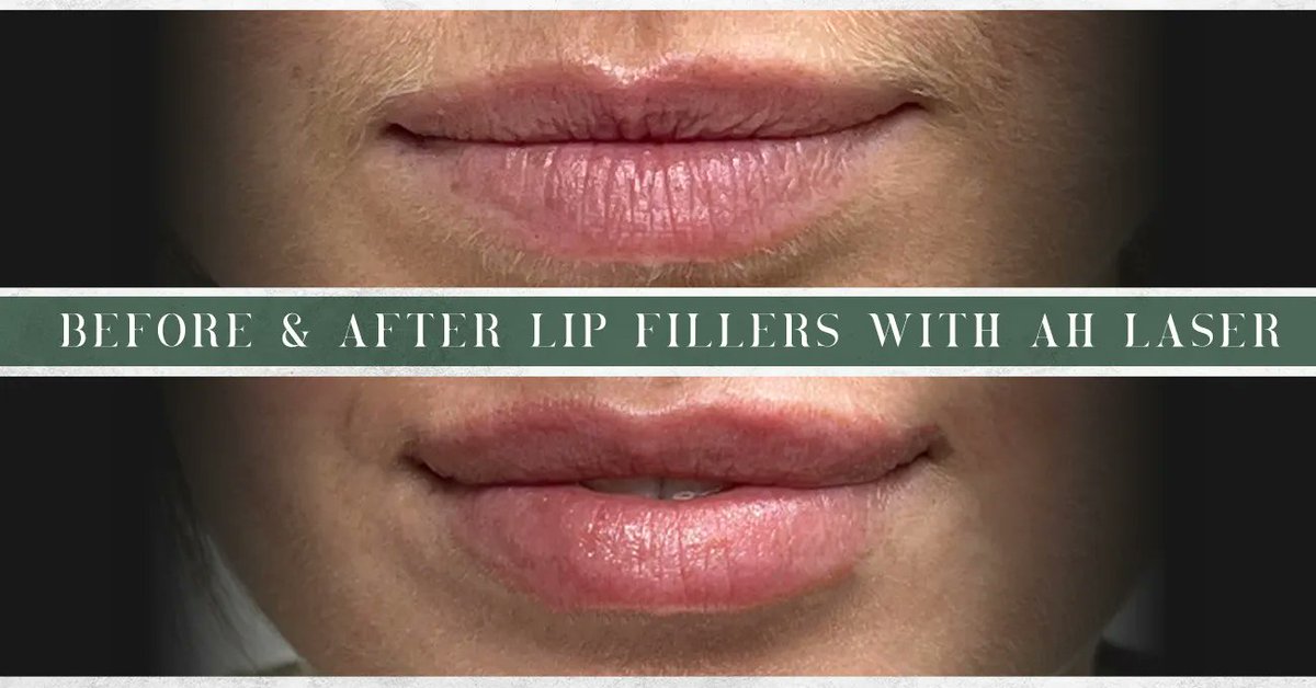 AHLaser's tweet photo. Seeking more hydrated, fuller-looking lips? AH Laser provides several options:

💋 #Juvéderm®: $650
💋 #Volbella®: $750
💋 #Versa: $550 (half-syringe available for $325)

Get in touch with our team to learn which option is best for you!

📞 (847) 255-7474 https://t.co/Ev0Xla1hLz