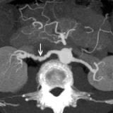 F. Silhol discussing causes and management of renal artery’s dissection ⁦<a href="/CNCFCardio/">CNCFCardio</a>⁩