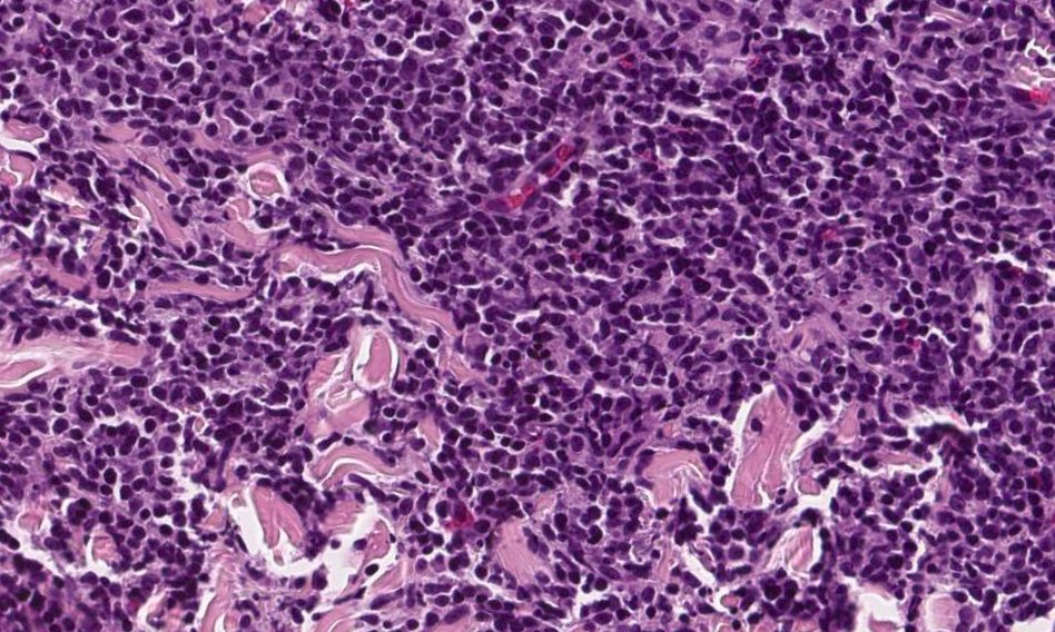 #BPDCN involving the skin & harboring pathogenic TET2, ASXL1 & ZRSR2 mutations

Concurrent bone marrow biopsy was negative for OVERT morphologic/immunophenotypic evidence of involvement by a myeloid neoplasm or BPDCN

#leusm #hemepath #MedTwitter #PathTwitter #mpnsm