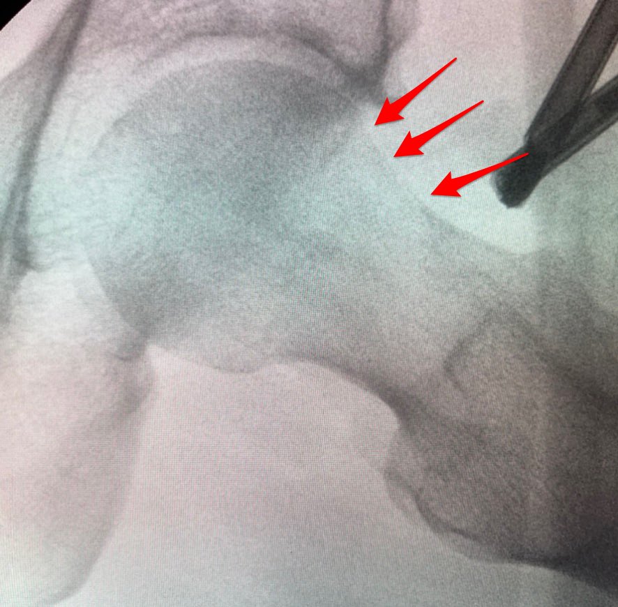 BILATERAL HIP ARTHROSCOPY 
#hiparthroscopy #hipsurgery #hipscope #hiphealth