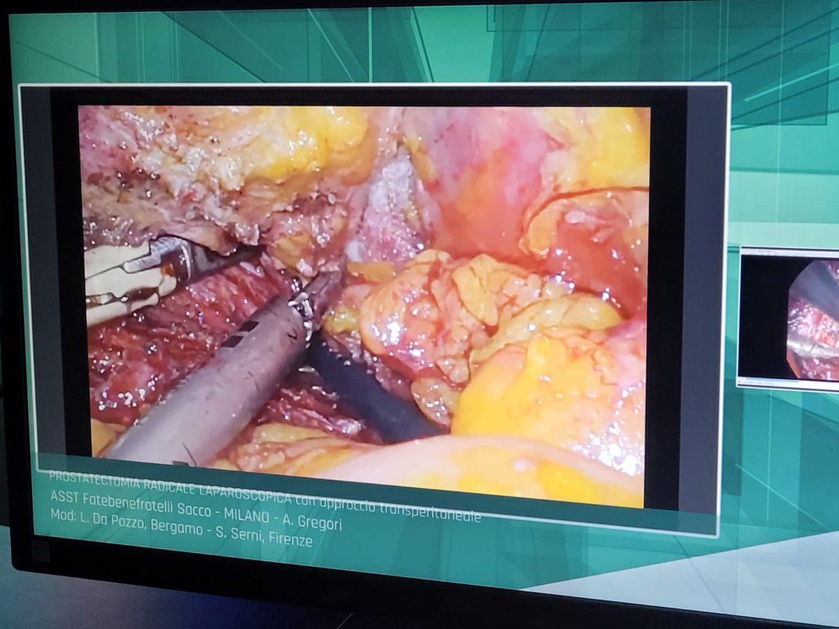 lorusso_MD's tweet photo. Amazed by Dr. Andrea Gregori speaking and presenting a wonderful Laparoscopic Radical Prostatectomy performed at #ASSTFatebenefratelli @MicheleTalso during #SIULIVE23 @SIU_Italia 

#urology #urosome #radicalprostatectomy #prostate #cancer #laparoscopy #3D #milan https://t.co/v0hSdUGBxm