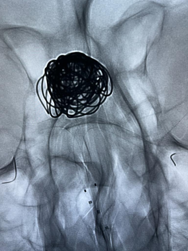 73 años, hallazgo incidental. Jailing con doble stent diversor más coils.