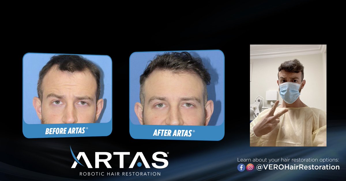 VenusHairAI's tweet photo. Here is the moment we’ve all been waiting for! … it’s been over a year now since Cameron Hamilton (@camrhamilton)  from Love Is Blind on Netflix had the ARTAS® Robotic Hair Restoration performed by @drwolfeld, and we couldn’t be more excited to share the AMAZING results! https://t.co/HPl7jBPvLR