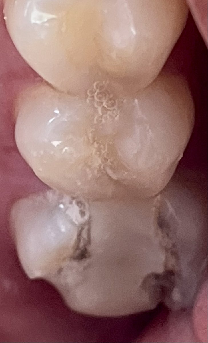talyaTheeEnby's tweet photo. Hey folks, I had a root canal a few years ago, and the filling recently fell out. The is cracked, and the pain is unbearable! I’m trying to raise $300 to fix it; please help! #crowdfunding #Emergency 
V: @irl_punch
C: $atthezoo94
https://t.co/ioFrnPUMRk https://t.co/VafCN0T6xN