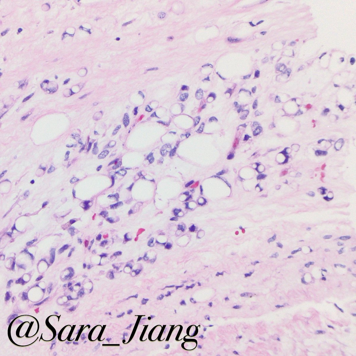 Sara_Jiang's tweet photo. Today’s #FNAFriday #CytoHisto correlation
🐓Chicken-wire vasculature, myxoid matrix, signet ring lipoblasts in myxoid liposarcoma
(DQ & H&E)
🧬t(12;16)(q13;p11.2) FUS-DDIT3 in most
👉🏼#PathPitfall: bubbly background and signet rings can raise c/f adenocarcinoma! https://t.co/jTFrksEd8J