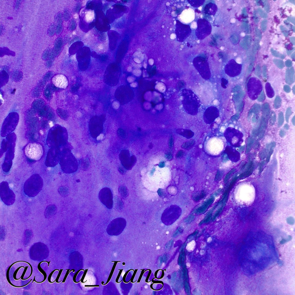 Sara_Jiang's tweet photo. Today’s #FNAFriday #CytoHisto correlation
🐓Chicken-wire vasculature, myxoid matrix, signet ring lipoblasts in myxoid liposarcoma
(DQ & H&E)
🧬t(12;16)(q13;p11.2) FUS-DDIT3 in most
👉🏼#PathPitfall: bubbly background and signet rings can raise c/f adenocarcinoma! https://t.co/jTFrksEd8J