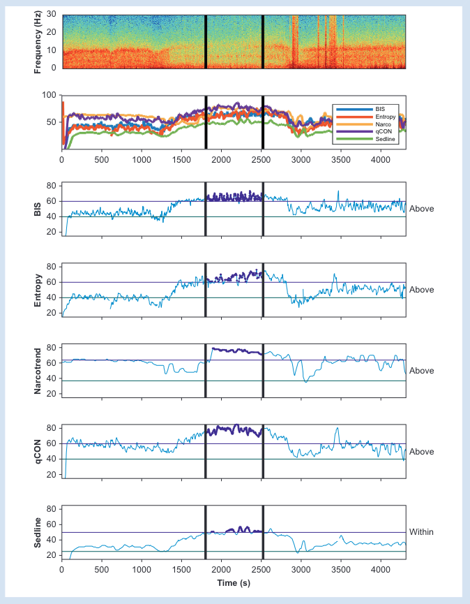 BJAJournals's tweet photo. New study by Hight et al showing agreement between five processed EEG monitors in only a third of cases during emergence from #anaesthesia.  

Is interpretation of EEG a clinical skill that anaesthetists should possess? #anesthesia #perioperative 

https://t.co/BP3vrXiD6U https://t.co/QsveXTN8Tx