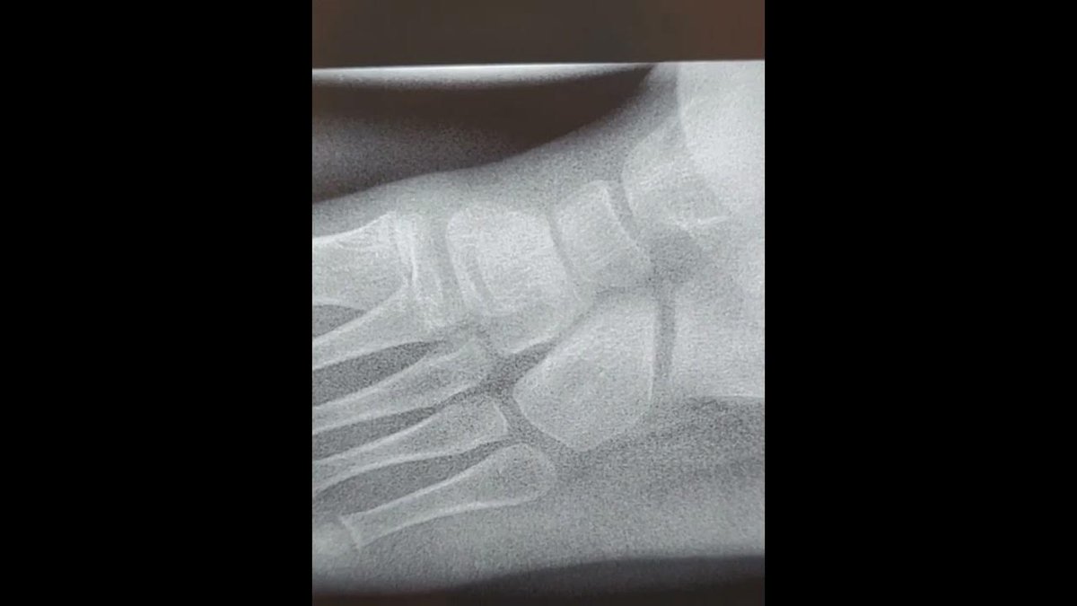 AlignMyFeet's tweet photo. "Hyprocure procedure and placate the posterior tibial tendon" - Dr. Elie C. Daniel
https://t.co/uoLNnf8R05 #hyprocure #eotts #footandankle #footpain #misalignedfeet #alignmyfeet https://t.co/joDubC1lRq
