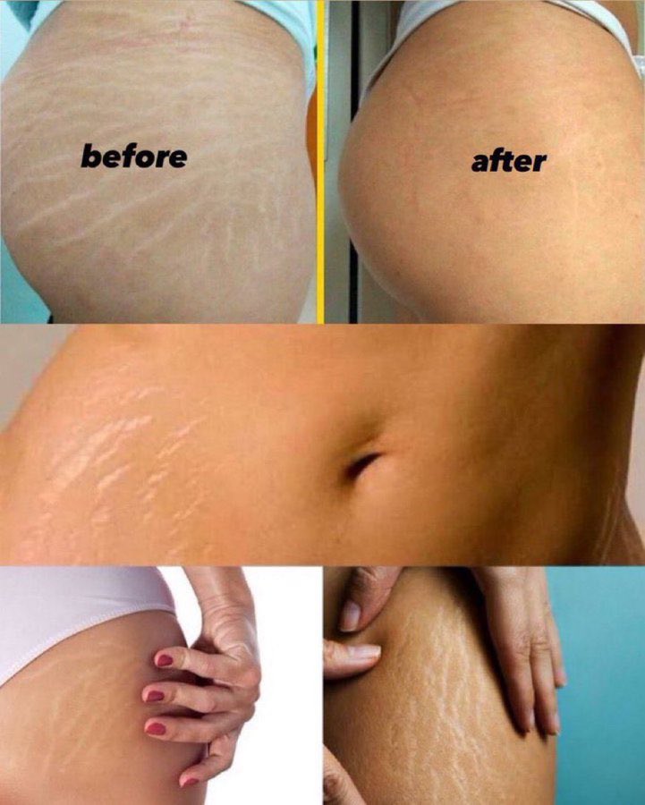 Best stretch mark remover!

a thread