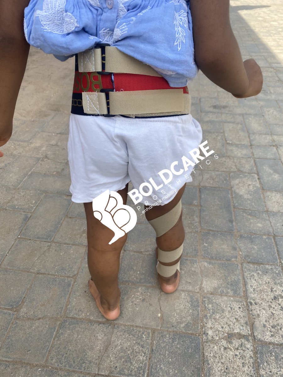 Boldcarepro's tweet photo. HIP ROTATION SPLINT: THIS IS USED TO CORRECT BILATERAL, UNILATERAL EXTERNAL OR INTERNAL ROTATION OF THE FOOT IN CHILDREN.
CONTACT US FOR PROSTHETIC/ORTHOTIC SERVICES⚙
@Hafeez_PT @cutieododo
@A_Loved_Baby
#orthotics
#OrthoticManagement
#pediatrics
#myprofession
#mypride https://t.co/fPchWYlqe7
