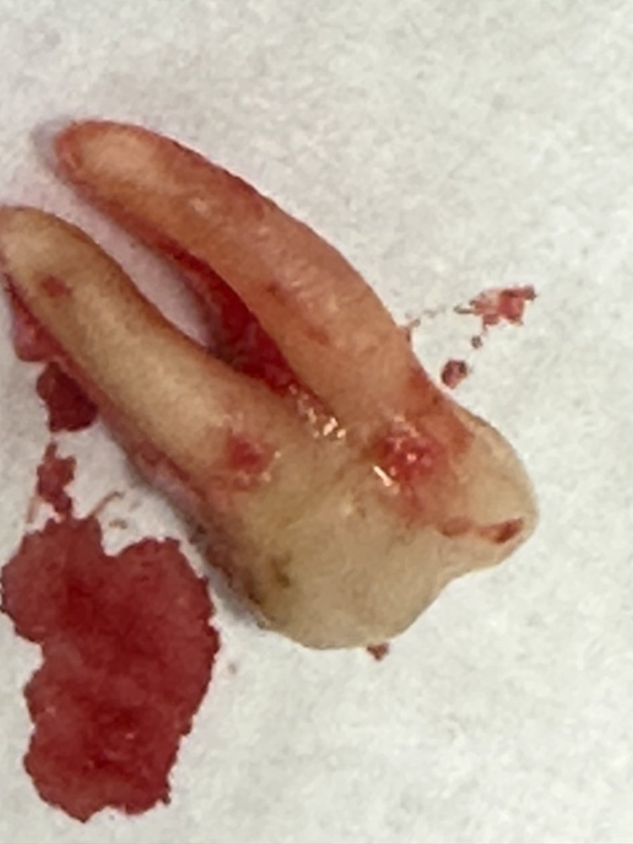 drdavidbull's tweet photo. Well that was a hideous start to the morning . Finally I had the courage to have my tooth out ! This pic is not for the faint of heart #dentalnightmare #tooth #notooth https://t.co/PGHgqUJ430
