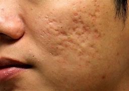 🎯¿Qué son las cicatrices atróficas?
Son las cicatrices deprimidas en la piel. Resultan cuando hay una regeneración incompleta de colágeno y tejido fibrinoso durante el proceso de cicatrización.