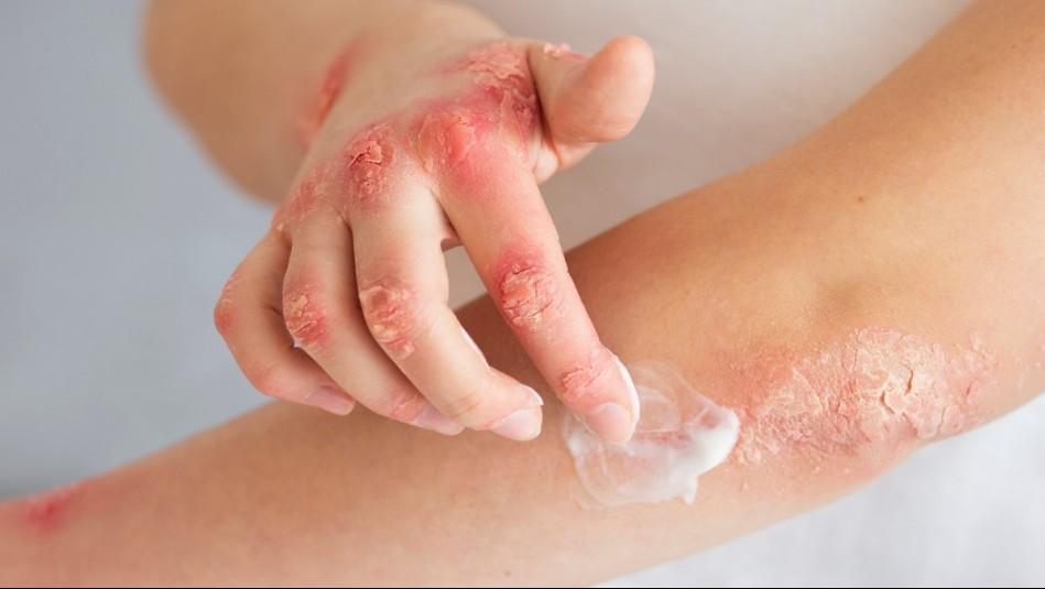 meganoticiascl's tweet photo. Tiene 98% de efectividad: Crema creada por científicos chilenos alivia los síntomas de la psoriasis https://t.co/W8xGxXAhBB https://t.co/4F8fBddClY