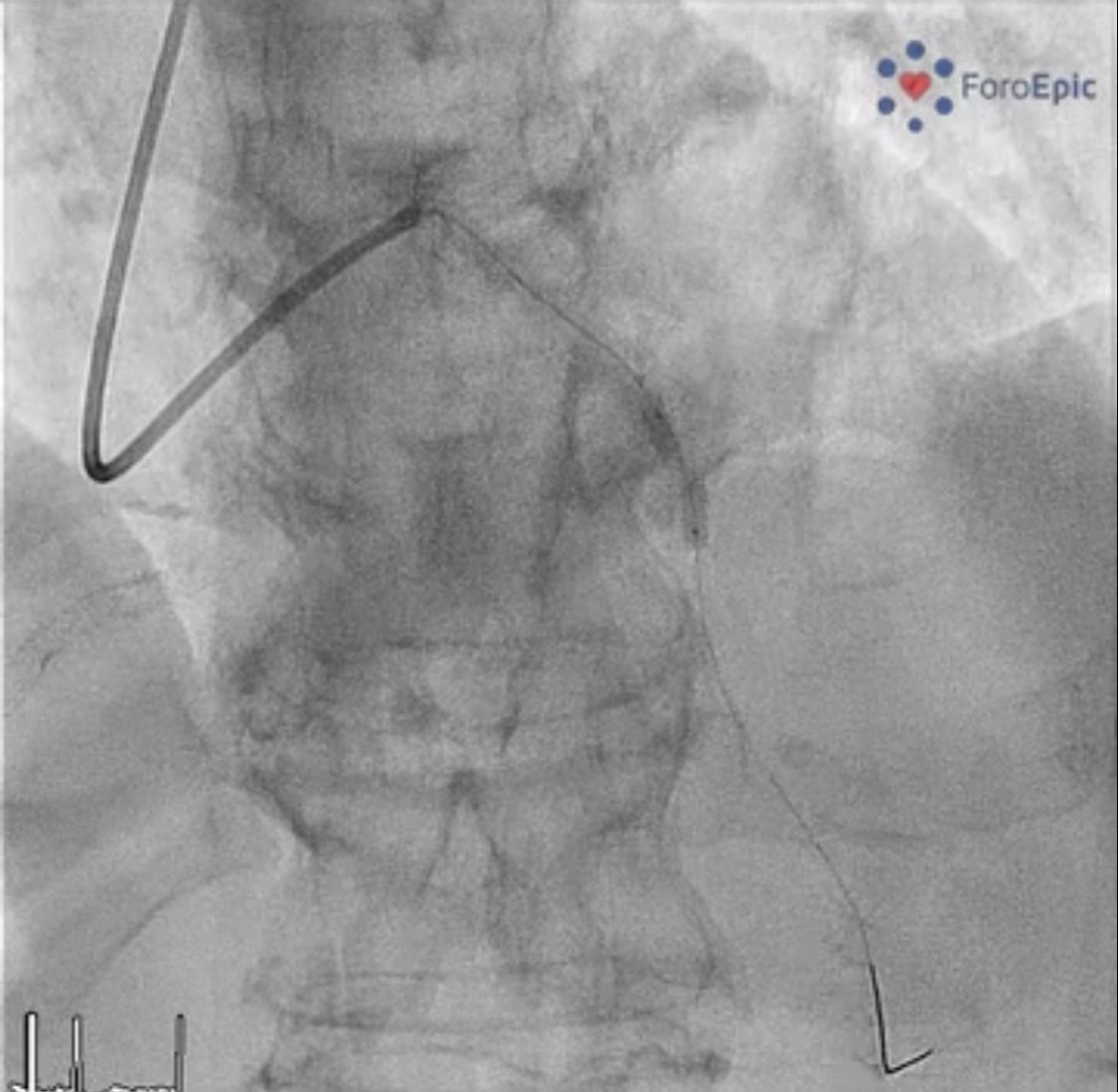 foroepic's tweet image. New case at foroepic.org 64 yo pt with NSTEMI. Moderate LV dysfunction. 2 vessel disease. PCI of RCA and staged PCI to LAD. #Orbital atherectomy but underexpansion of🎈 A stent is implanted with underexpansion🫣. What is your next move? 🧵⬇️