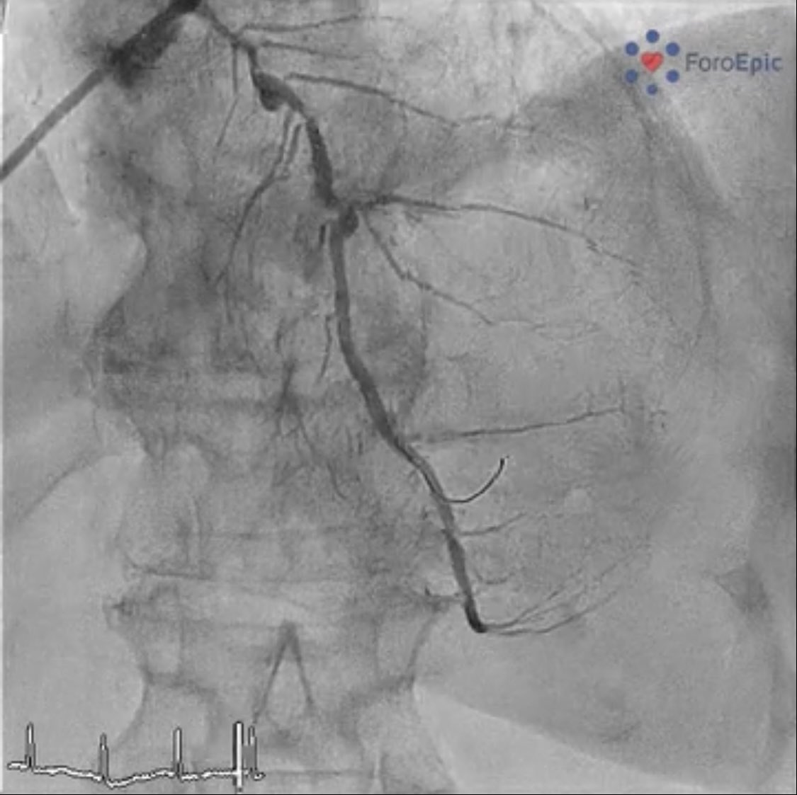 foroepic's tweet image. New case at foroepic.org 64 yo pt with NSTEMI. Moderate LV dysfunction. 2 vessel disease. PCI of RCA and staged PCI to LAD. #Orbital atherectomy but underexpansion of🎈 A stent is implanted with underexpansion🫣. What is your next move? 🧵⬇️