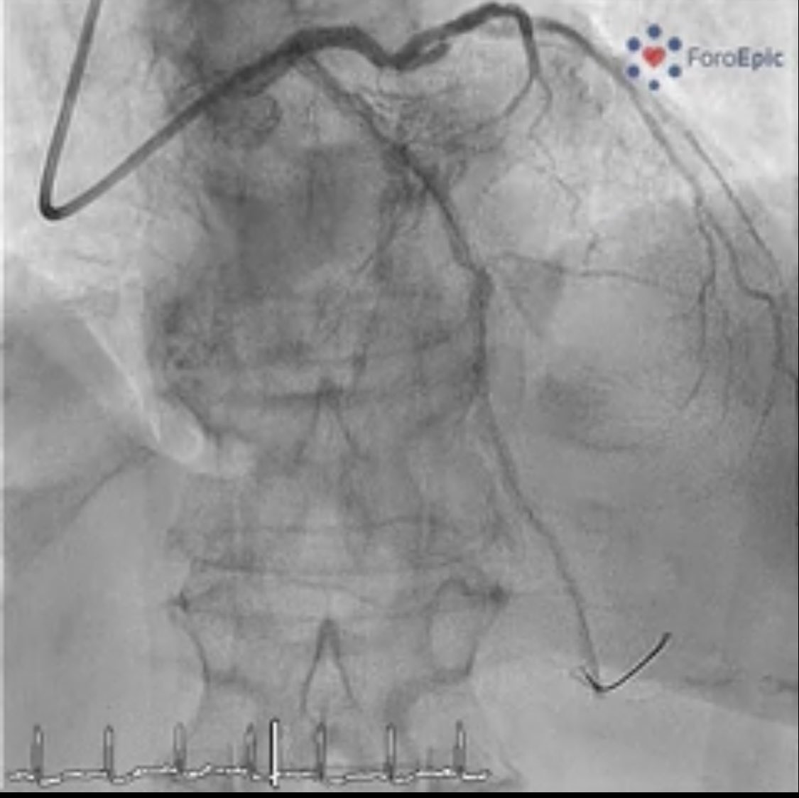 foroepic's tweet image. New case at foroepic.org 64 yo pt with NSTEMI. Moderate LV dysfunction. 2 vessel disease. PCI of RCA and staged PCI to LAD. #Orbital atherectomy but underexpansion of🎈 A stent is implanted with underexpansion🫣. What is your next move? 🧵⬇️