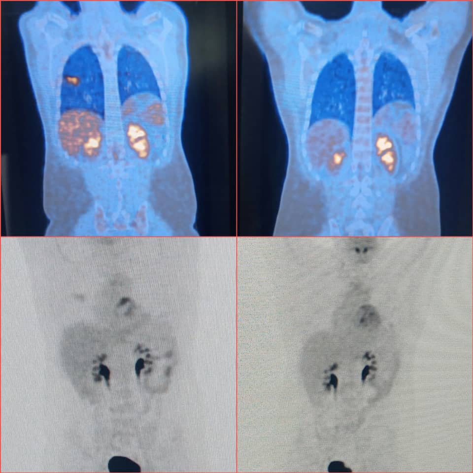 Los estudios PET-CT permiten estadificar a los pacientes con Linfoma, evaluar respuesta al tratamiento y predecir respuesta durante el tratamiento. Puede detectar cambios metabólicos cuando aún no son visibles por tomografía. #medicinanuclearameijeiras #clinicainternacionalhha