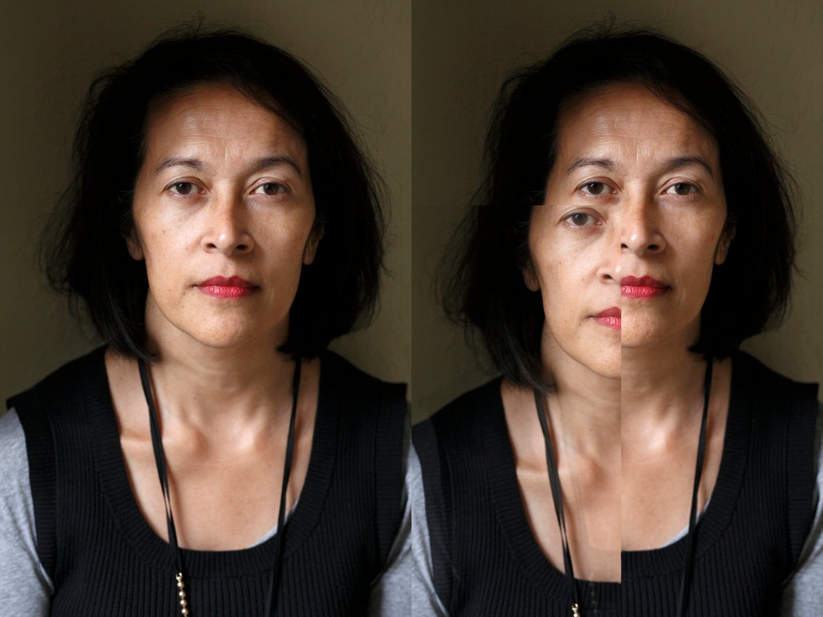 #Diplopia is one of the debilitating problems that some #strabismus sufferers have to cope with. In Face to Face with Strabismus, the psychological impact is discussed with Psychologist, Dr Silvia Riva <a href="/Riva1Silvia/">Silvia Riva</a>   @panfresca @LondonEyeDoc