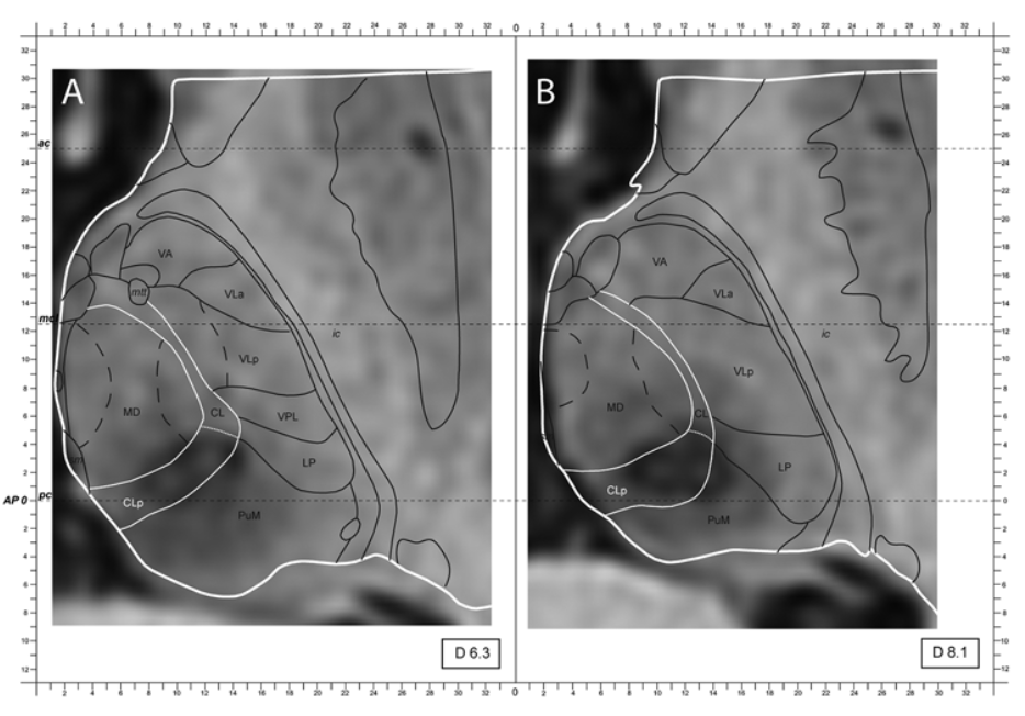 TheJNS's tweet image. #OnlineFirst: Magnetic resonance–guided focused ultrasound central lateral thalamotomy against chronic and therapy-resistant neuropathic pain: retrospective long-term follow-up analysis of 63 interventions. 

thejns.org/view/journals/….
