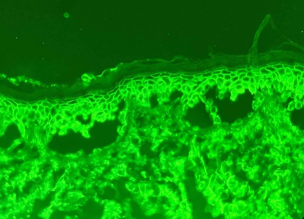 KCampbellMD's tweet photo. As our current PGY-5 and future @DalPathology #dermpath fellow @AK2433 said: “it’s a graveyard up in there!” 🪦🪦🪦 great classic case of pemphigus vulgaris! https://t.co/Hl3l5GClV7