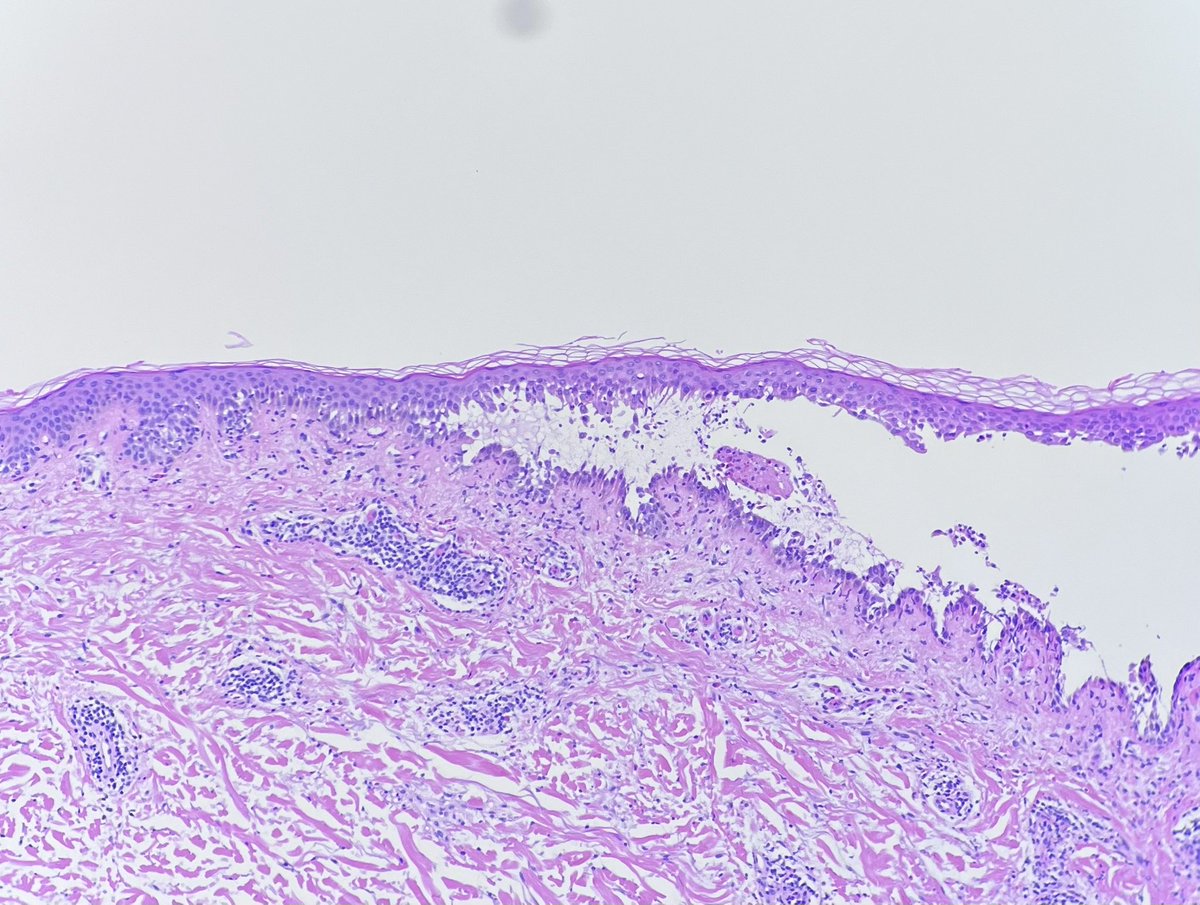 KCampbellMD's tweet photo. As our current PGY-5 and future @DalPathology #dermpath fellow @AK2433 said: “it’s a graveyard up in there!” 🪦🪦🪦 great classic case of pemphigus vulgaris! https://t.co/Hl3l5GClV7