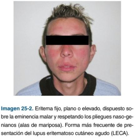 NicoV2516's tweet photo. LES en adultos:
- Prevalencia: Mujeres
- Síntomas comunes: fatiga, dolor articular y perdida de peso involuntaria
- compromiso musculoesquelético: 90% mucocutáneo: 80%
Gastrointestinales : 40% https://t.co/xJr5hqToAA