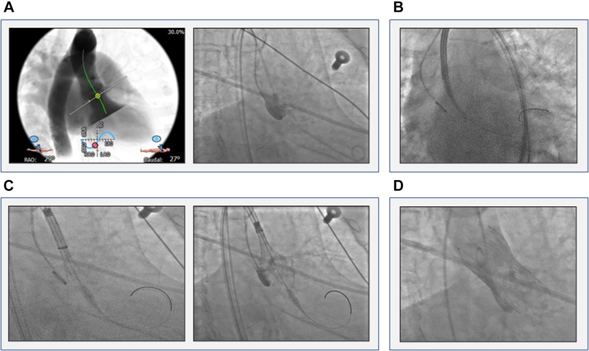 GilbertTangMD's tweet photo. Congrats @KendraGrubb @StevenYakubov et al for OPTIMIZE PRO #EvolutPRO(+) #TAVR just out @JACCJournals #JACCINT showing less PPM with best practices. EvolutFX even better with optional Lundi wire use. @tnazifMD @JoshuaRovin @PaulMahoneyMD @anvoramd https://t.co/WgK8BzB6jC https://t.co/quEN1XUYIX